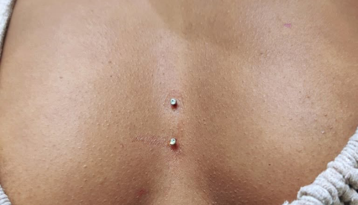 Piercing de surface composé de deux embouts métalliques posé chez Atyka Body Works à Toulouse
